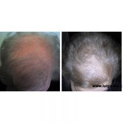 alopecia_androgenetica_nella_donna