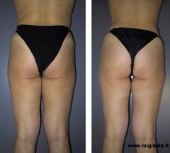 endermologie