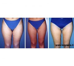 endermologie_fianchi