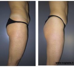 endermologie_un_ciclo