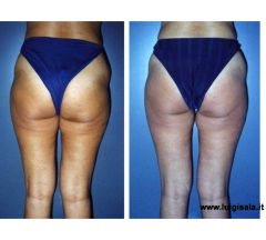 trattamento_endermologie