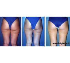trattamento_prima_dopo_endermologie