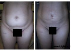 liposcultura_addome