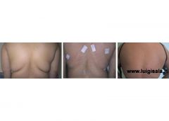 liposcultura_dorso