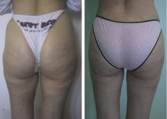 liposcultura_fianchi_coulotte