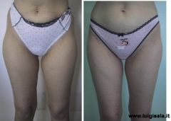 liposcultura_fianchi_e_coulotte