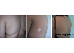 liposcultura_regione_dorsale