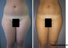 liposcultura_regione_trocanterica