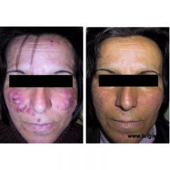 grave_forma_di_rosacea