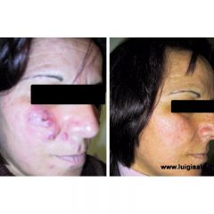 grave_rosacea